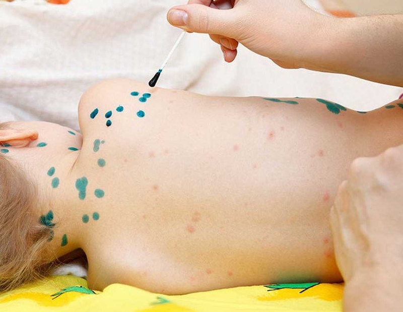 Trẻ sơ sinh bị thủy đậu bôi thuốc gì là câu hỏi thắc mắc của nhiều bậc phụ huynh