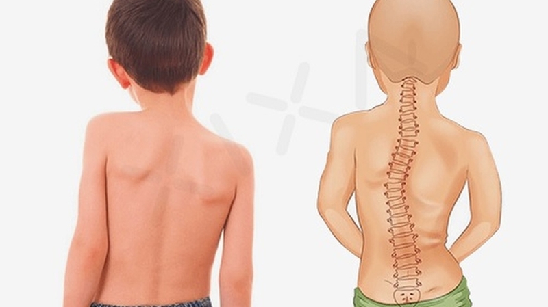 Trẻ sơ sinh ngồi bị cong lưng: Nguyên nhân và cách khắc phục 3