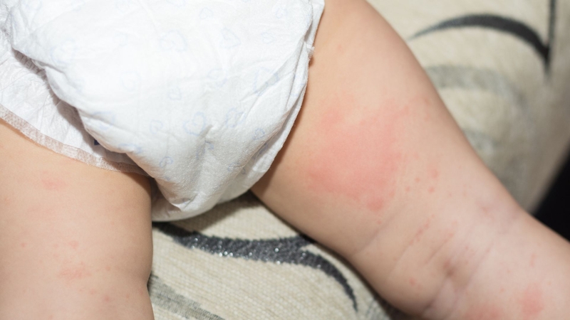 Do tã ẩm lâu, ma sát hoặc da nhạy cảm