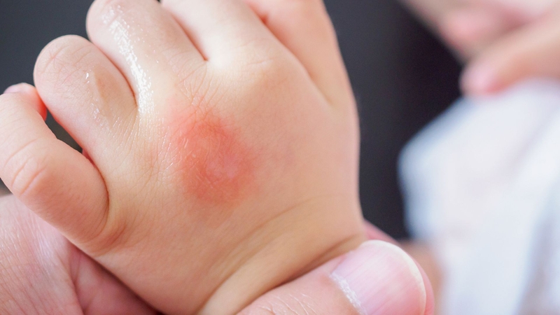 Trẻ sơ sinh nổi mẩn đỏ là tình trạng xuất hiện các nốt hoặc mảng đỏ trên da