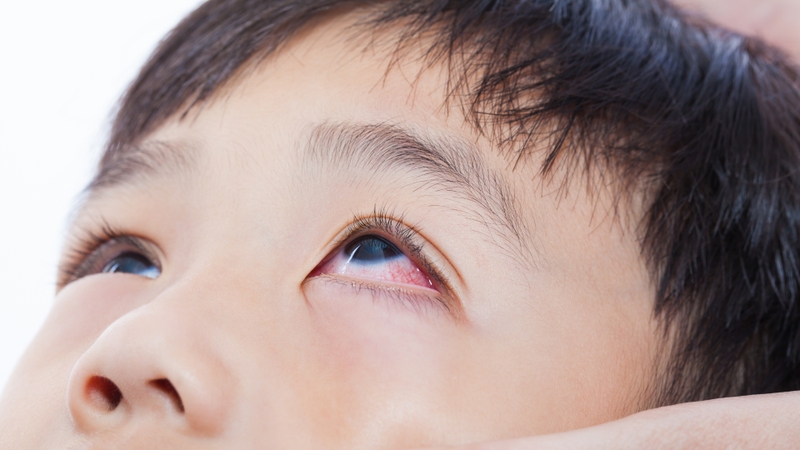 Bên cạnh sốt, trẻ có thể bị đau mắt đỏ khi nhiễm Adenovirus