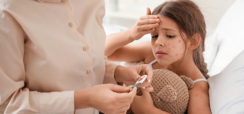 Trẻ sốt xong bị nổi mẩn đỏ: Nguyên nhân và cách xử lý 1