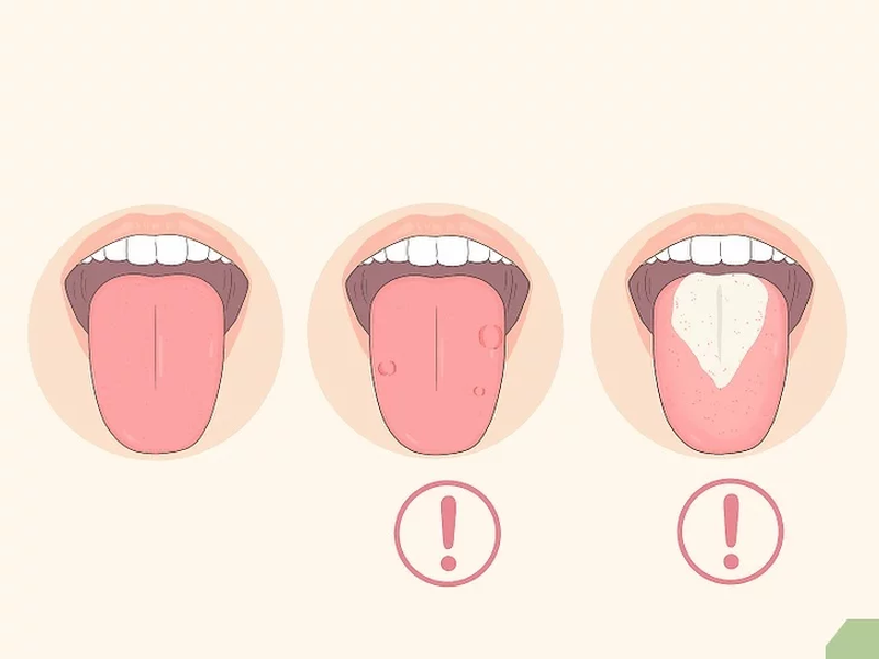 Trẻ viêm lưỡi bản đồ phải làm sao? Tổng hợp những phương pháp phòng bệnh hiệu quả