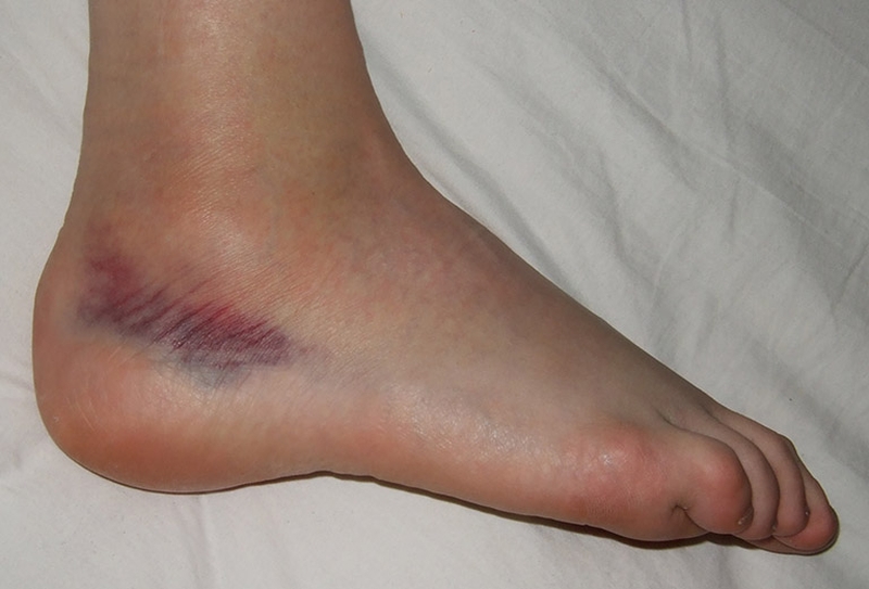 Mách bạn những cách chữa trị đá bóng bị trẹo cổ chân tại nhà 1