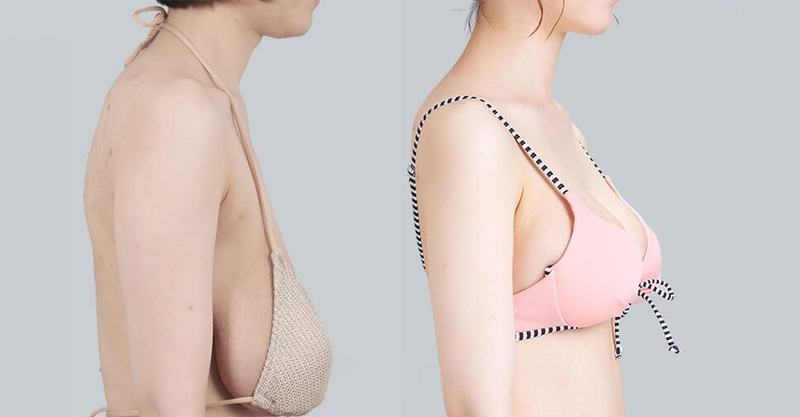 Treo ngực sa trễ là gì? 2