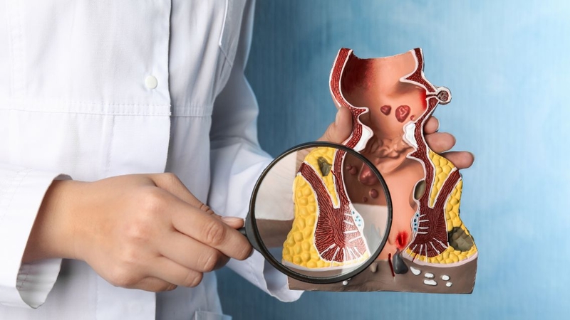 Trĩ cấp độ 3 uống thuốc có khỏi không? Cách điều trị trĩ độ 3 hiệu quả 4