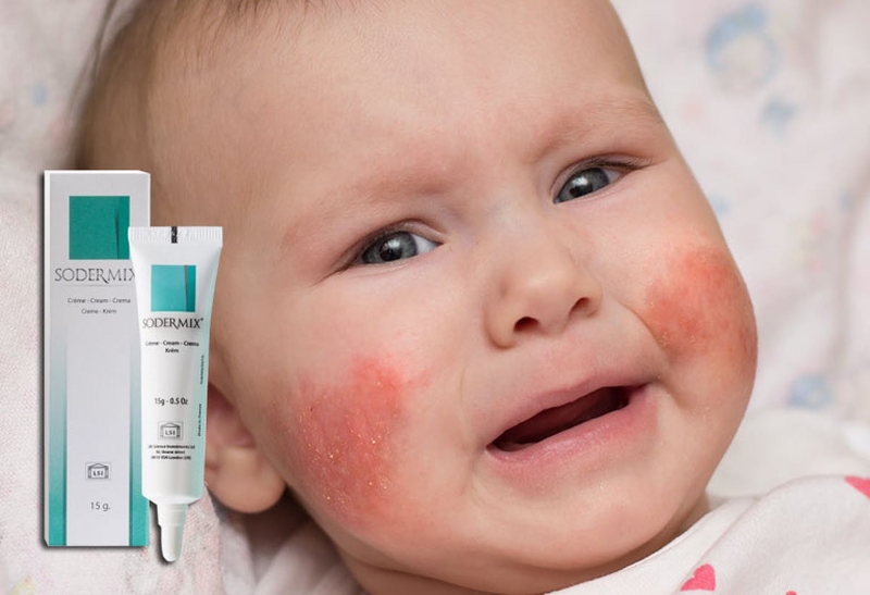 Kem Sodermix hỗ trợ điều trị chàm sữa hiệu quả