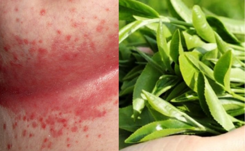 Trị hăm tã bằng trà xanh 1