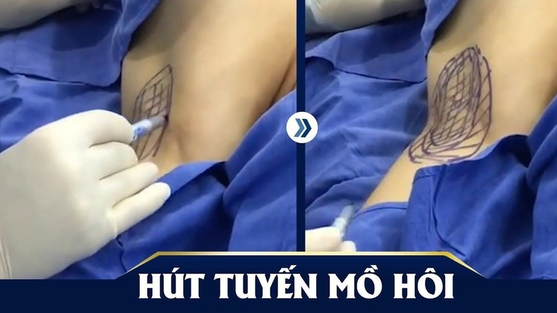 Trị hôi nách Endo Dry là gì? Có hiệu quả không? 1