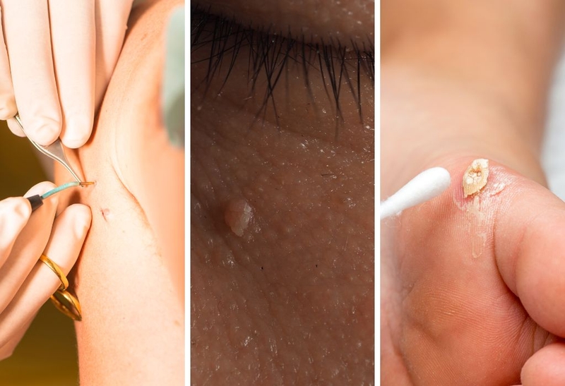 Trị mụn cóc bằng chanh tại nhà khiến da đẹp chỉ sau 1 tuần 2