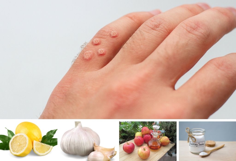 Trị mụn cóc bằng chanh tại nhà khiến da đẹp chỉ sau 1 tuần 3