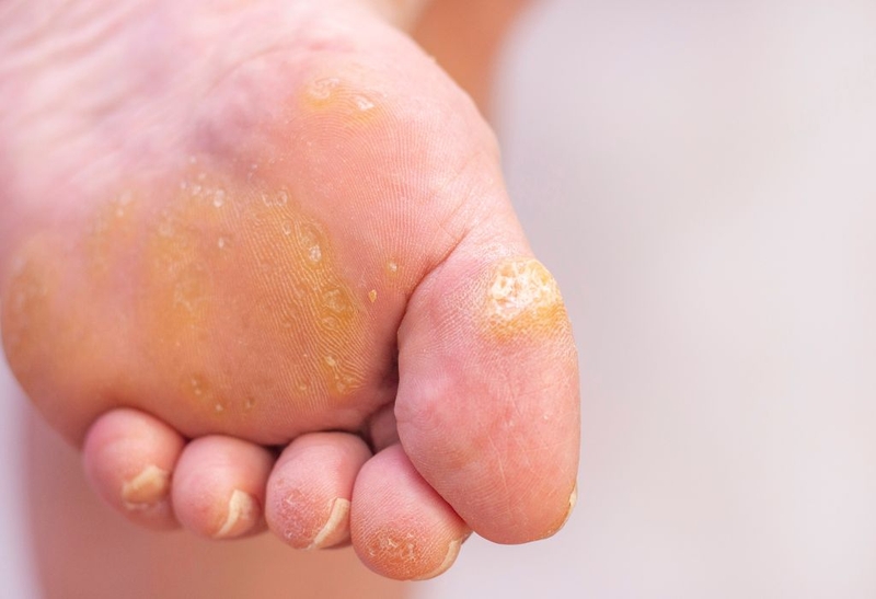 Trị mụn cóc bằng hành tím được bác sĩ khuyên dùng 1