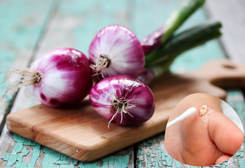 Trị mụn cóc bằng hành tím được bác sĩ khuyên dùng