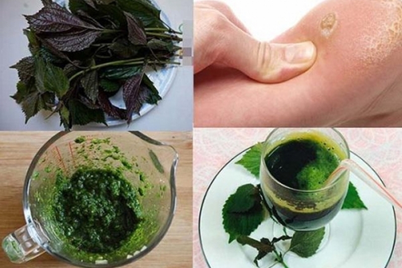 Cách trị mụn cóc bằng lá tía tô hiệu quả tại nhà 3