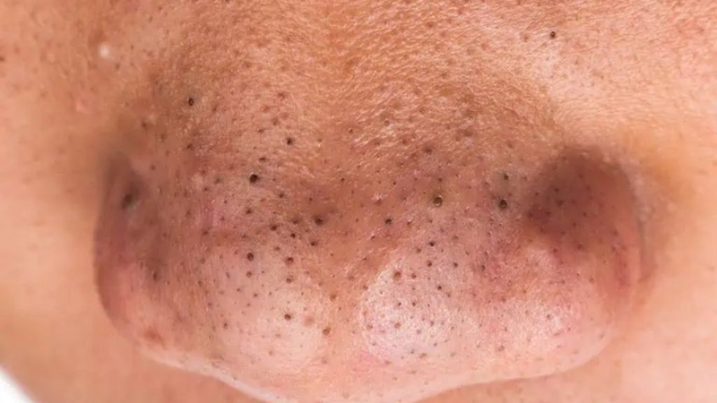 Trị mụn đầu đen ở mũi bằng BHA và những lưu ý cần biết 1