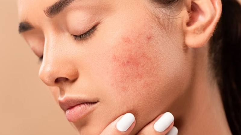 Trị mụn đầu đen ở mũi bằng BHA và những lưu ý cần biết 3