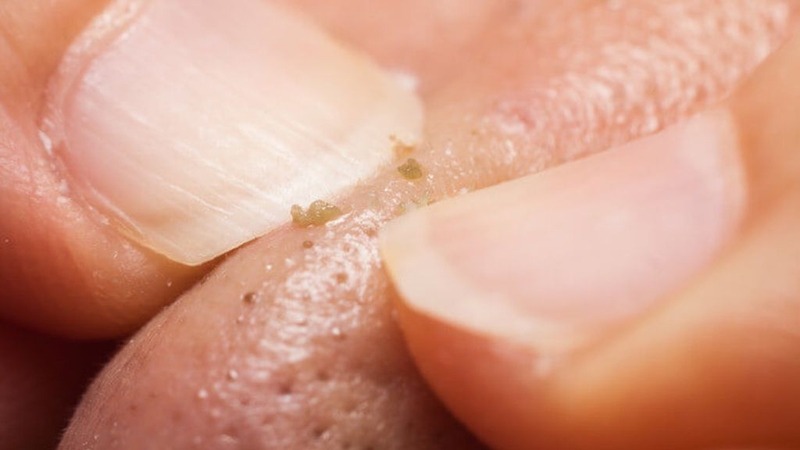 Trị mụn đầu đen tại nhà bằng sữa chua: Thực hiện ra sao?  1