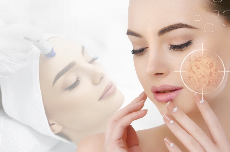 Trị nám bằng laser bao nhiêu tiền? Có hiệu quả không 3