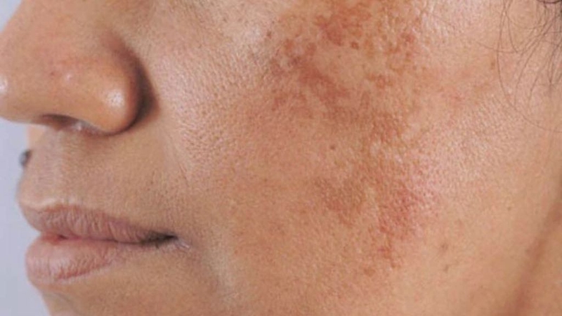 Trị nám bằng Laser Picosure có tốt không? Cần lưu ý điều gì? 1