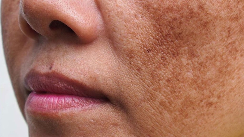 Trị nám Pico Cell giá bao nhiêu? Hiệu quả như thế nào? 1