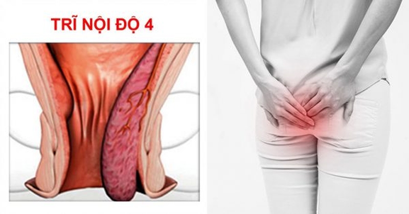 Hình ảnh bệnh trĩ nội và bệnh trĩ ngoại theo 4 cấp độ 4
