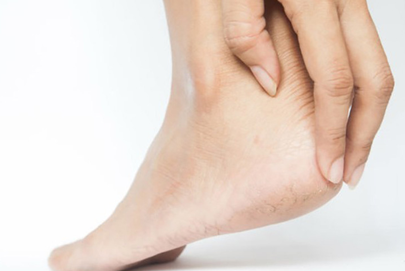 Trị nứt gót chân bằng chuối, giải pháp tự nhiên tốt cho da 1