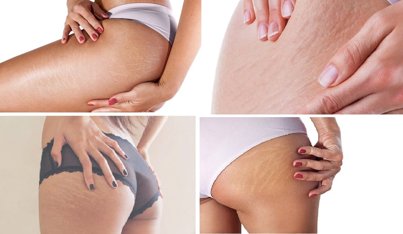 trị rạn da mông lâu năm 1