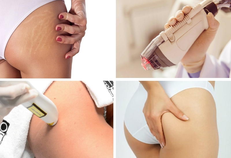 trị rạn da sau sinh bằng laser 2