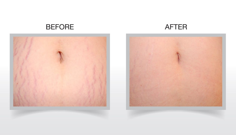 trị rạn da sau sinh bằng laser 3