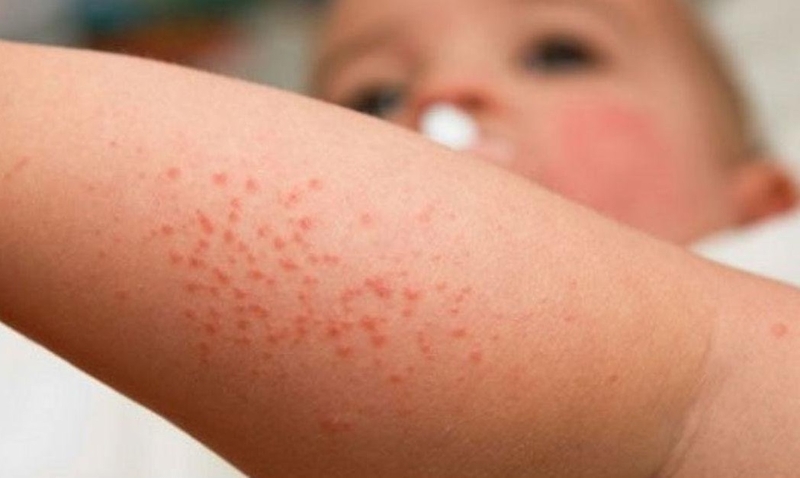 trị rôm sảy bằng lá khế 4