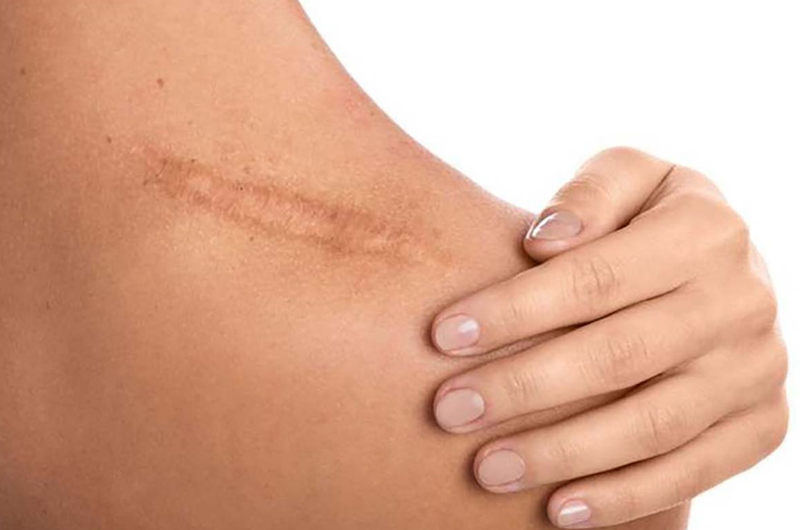 Trị sẹo bằng vitamin E có phải là phương pháp duy nhất? 1