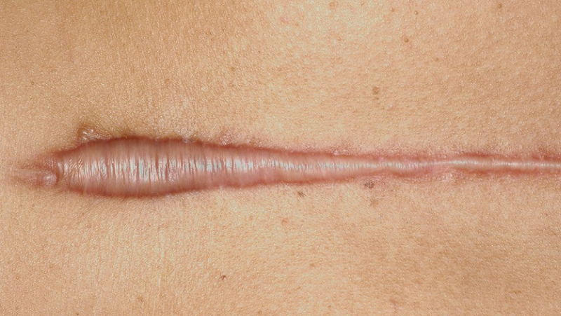 Cách trị sẹo lồi mới hình thành