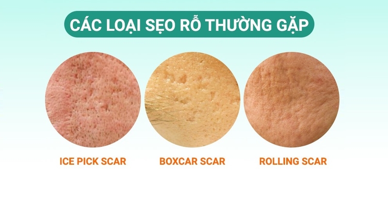 trị sẹo rỗ bằng retinol 2