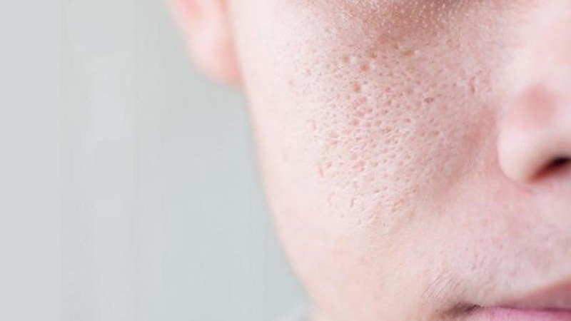 Trị sẹo rỗ có đau không? Các phương pháp điều trị hiệu quả 3