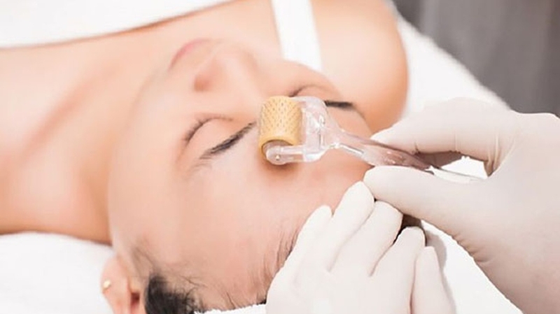 Trị sẹo rỗ có đau không? Các phương pháp điều trị hiệu quả 2