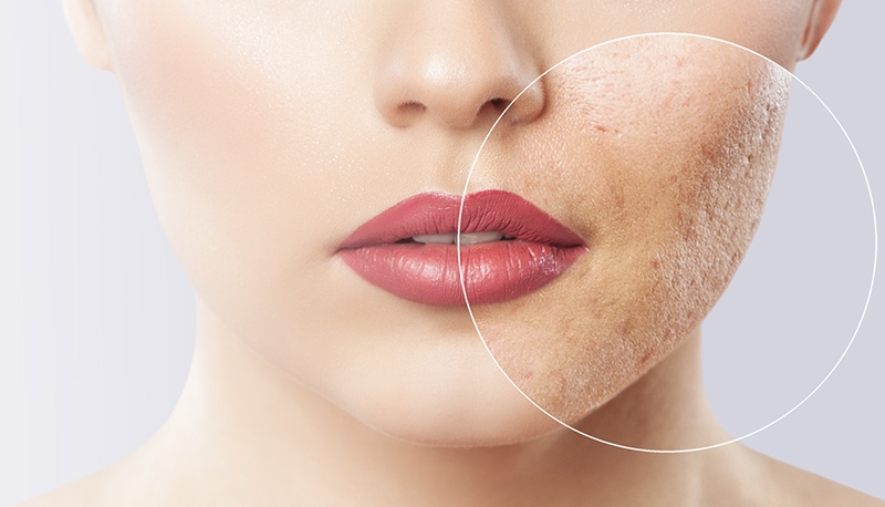 Trị sẹo rỗ đáy vuông hiệu quả - Nỗi băn khoăn của nhiều người 2