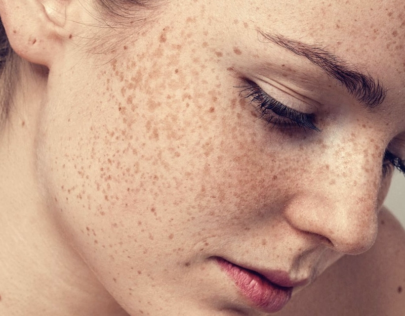 Trị tàn nhang bằng thuốc Đông y có tốt không? 1