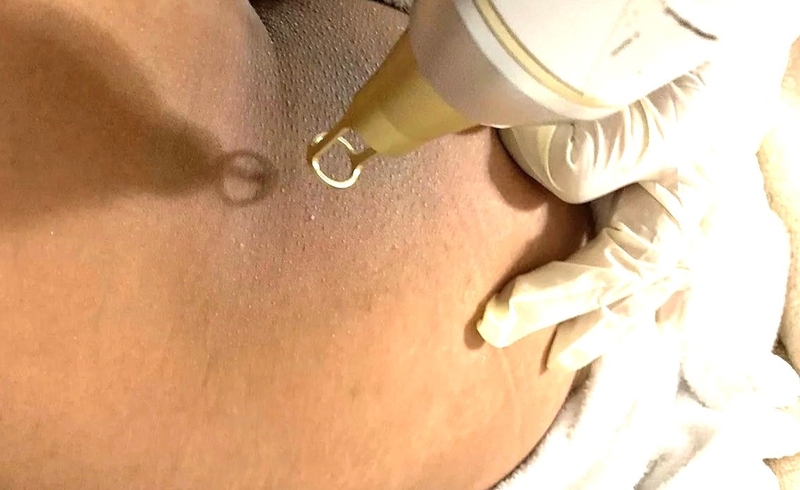 Trị thâm mông bằng laser giá bao nhiêu 3