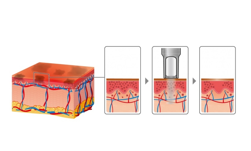 Trị thâm mông bằng laser giá bao nhiêu 2