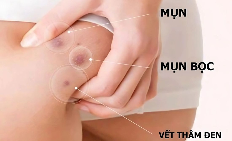 Trị thâm mông bằng laser giá bao nhiêu 1