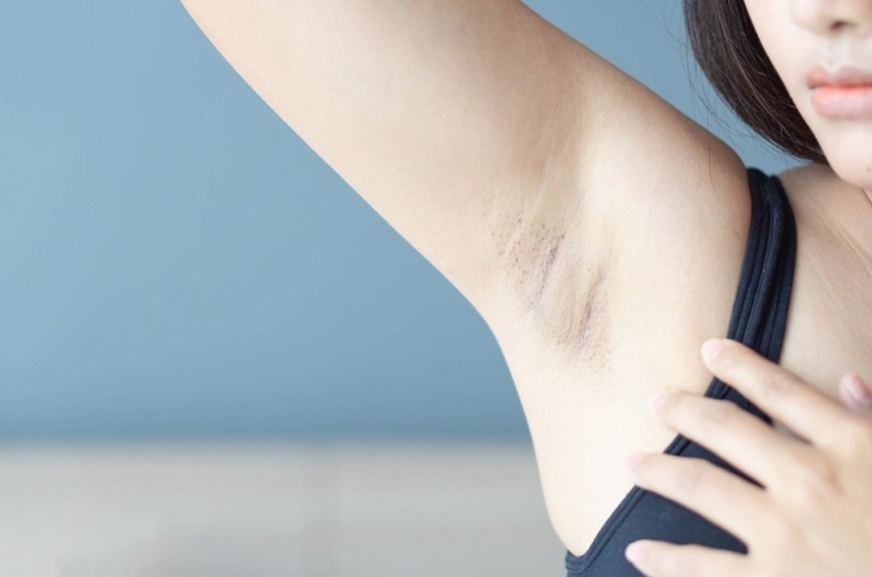 trị thâm nách sau sinh bằng dầu dừa 1