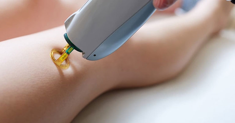 Hướng dẫn chăm sóc da sau khi trị viêm nang lông với máy laser