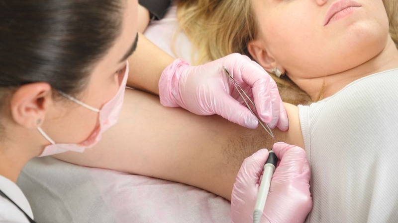 Triệt lông điện phân là gì? Phương pháp triệt lông hiệu quả và lâu dài 2