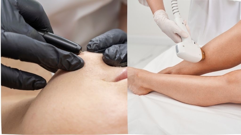 Triệt lông điện phân là gì? Phương pháp triệt lông hiệu quả và lâu dài 3