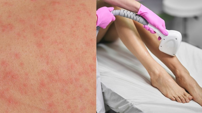 Triệt lông điện phân và những điều cần biết 3