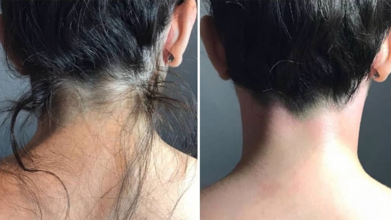 triet-long-gay-la-gi-co-nen-triet-long-gay 3