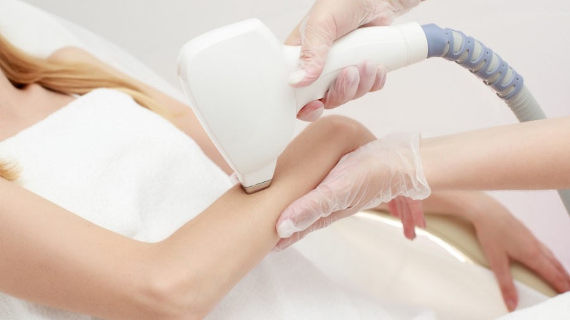 Triệt lông tay vĩnh viễn và những điều cần biết 1