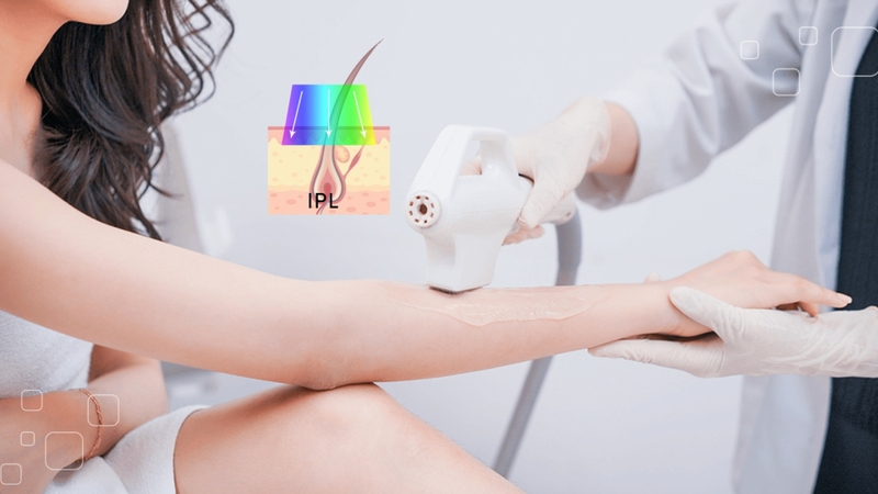 Triệt lông vĩnh viễn là gì? Các phương pháp triệt lông phổ biến hiện nay 4