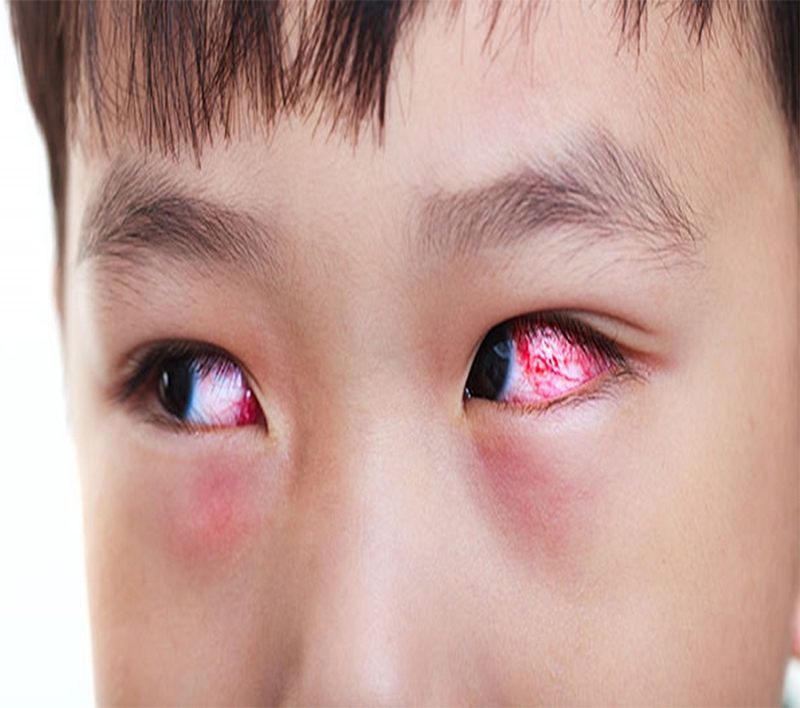 Triệu chứng bệnh đau mắt đỏ: đau mắt đỏ ngứa không 1