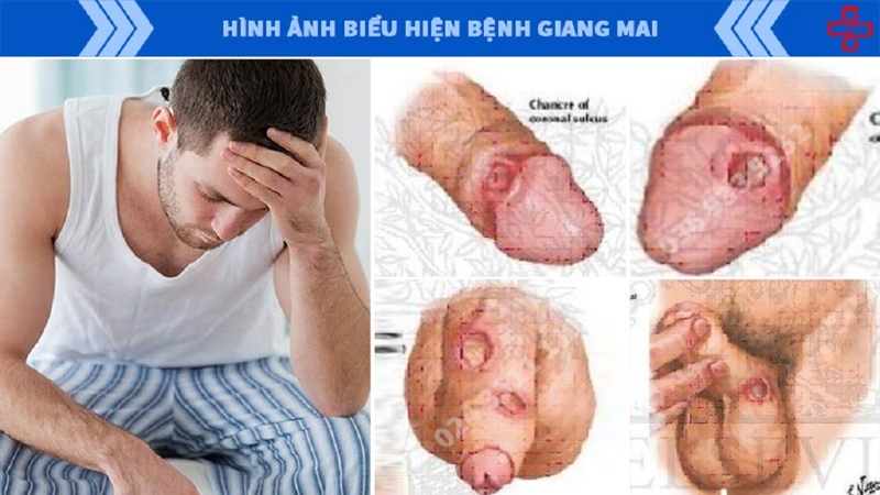 Bệnh giang mai ở nam giới có thể chữa khỏi hay không phụ thuộc vào giai đoạn hiện tại của bệnh